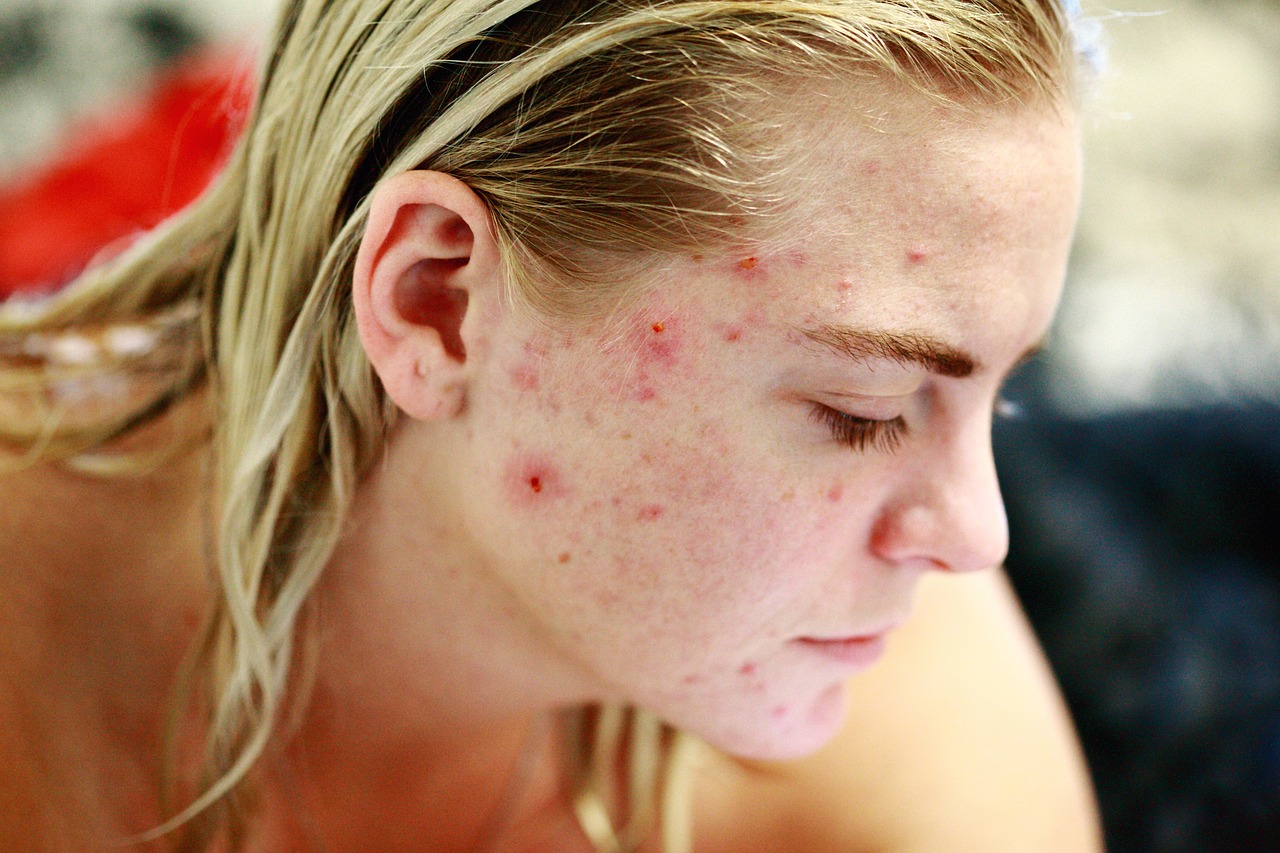 Transform Your Skin: Acne Treatment Results